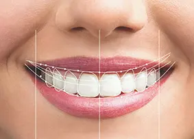 tratamiento diseño sonrisa