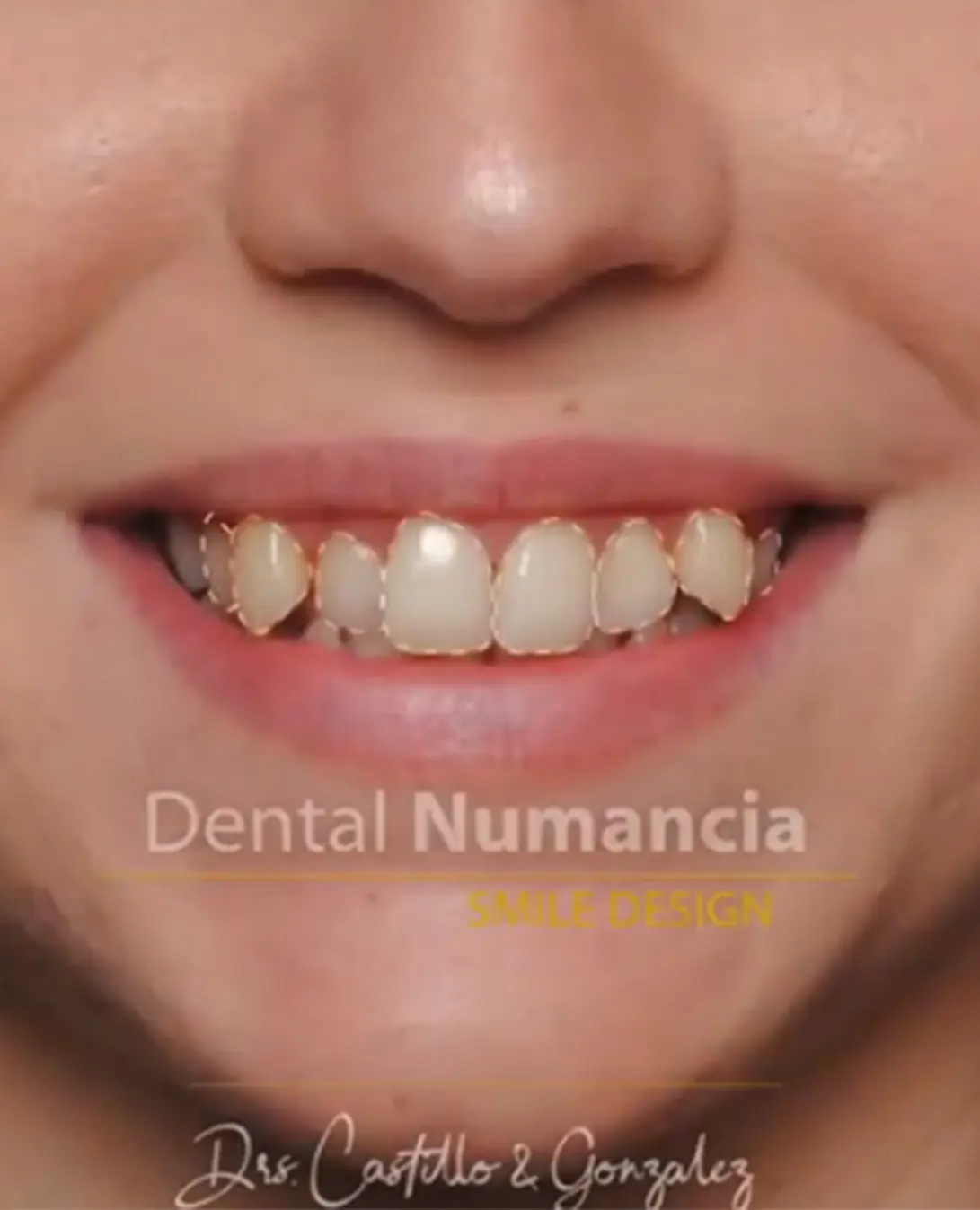 ortodoncia invisaling santa cruz de tenerife